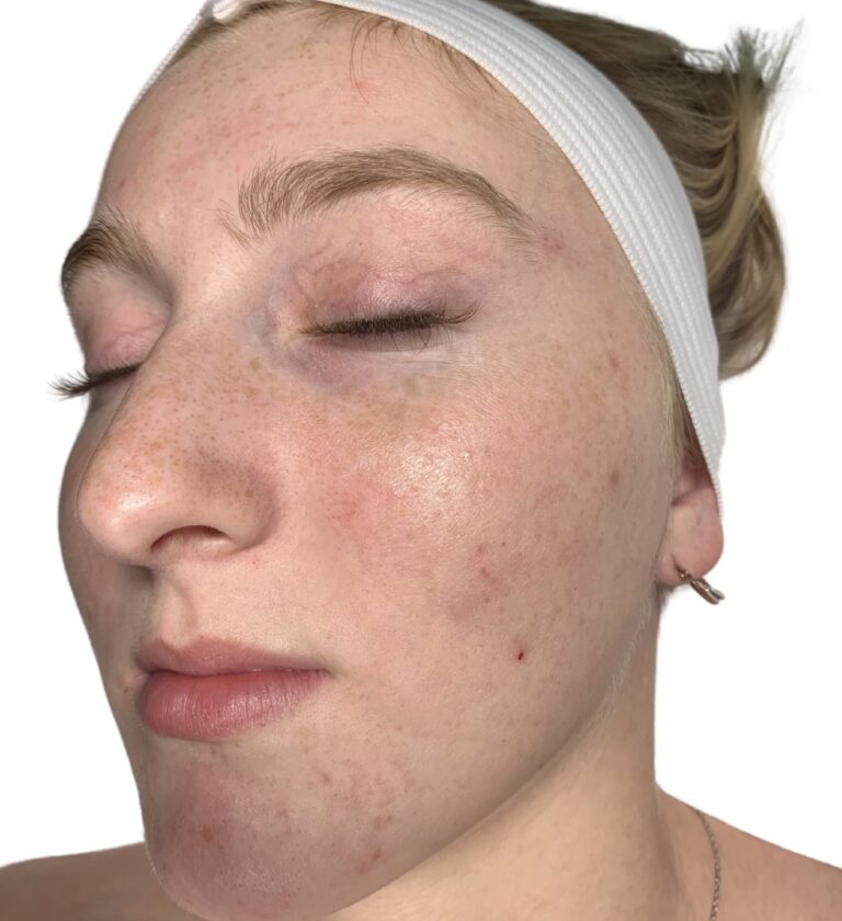 After Image: Acne Chemical Peel - front
