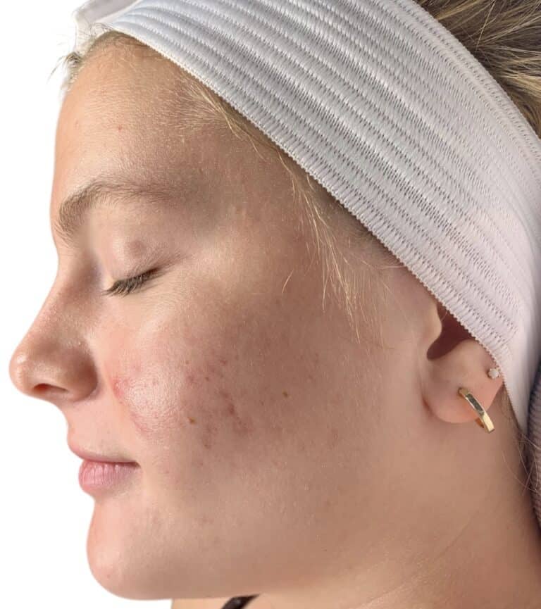 After Image: Acne Chemical Peel - front