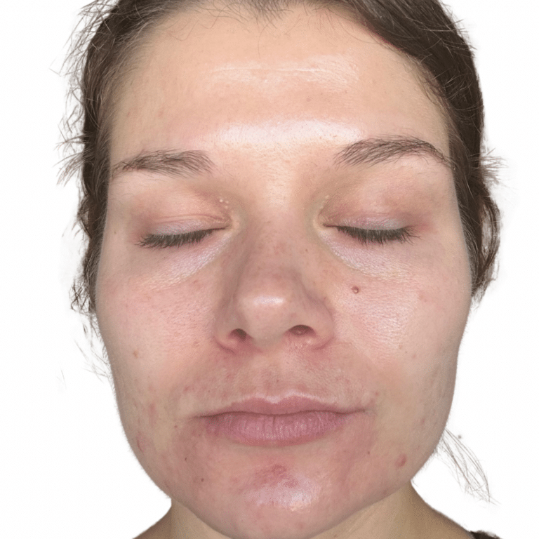 After Image: Acne Chemical Peel - other