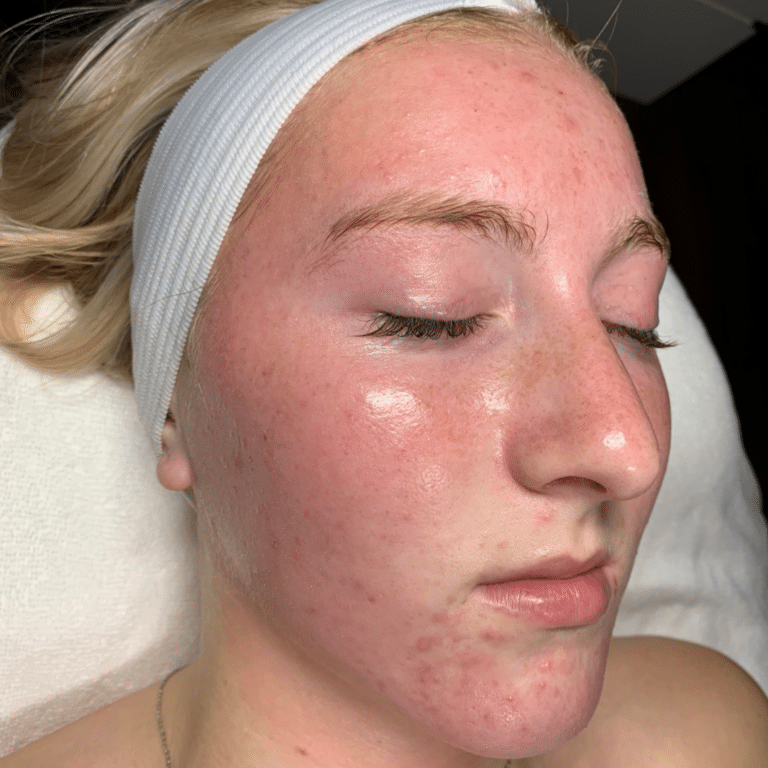 Before Image: Acne Chemical Peel - front