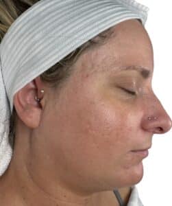 After Image: Microneedling