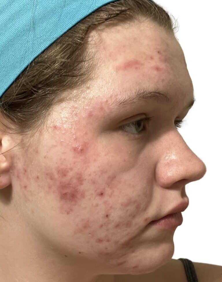 Before Image: Acne Chemical Peel - front