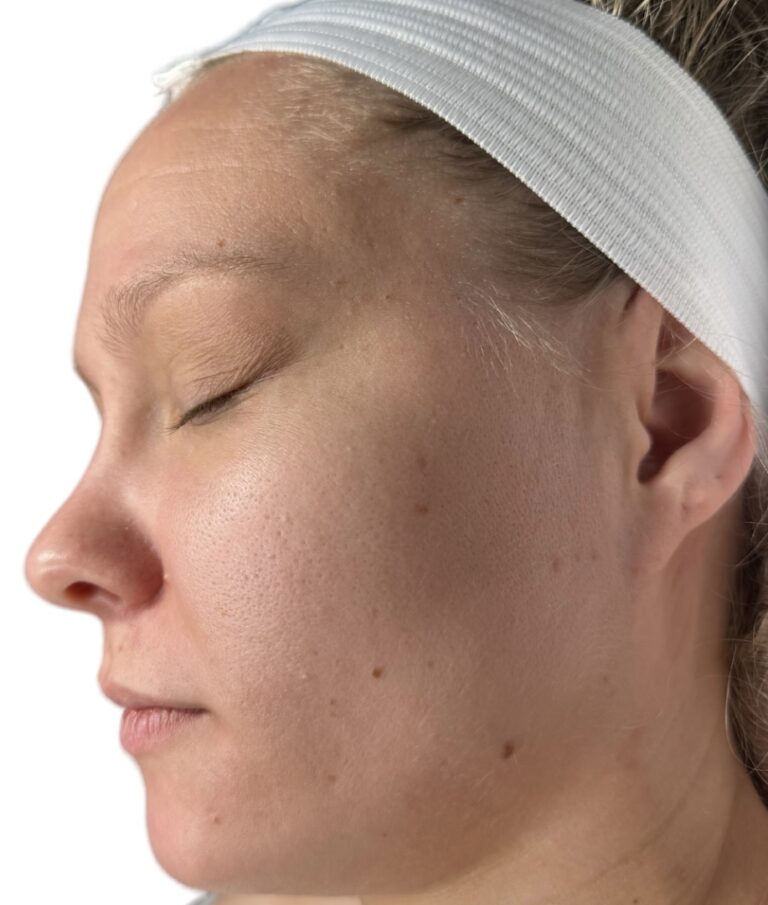 After Image: Acne Chemical Peel - front