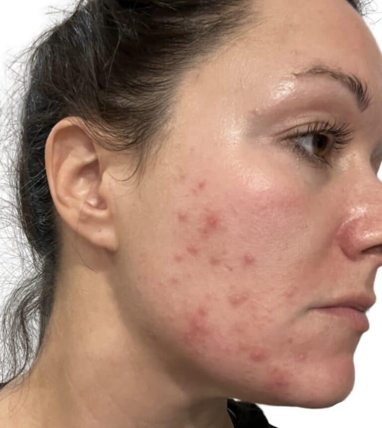 Before Image: Acne Chemical Peel -