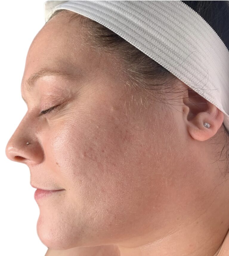 After Image: Acne Chemical Peel - front