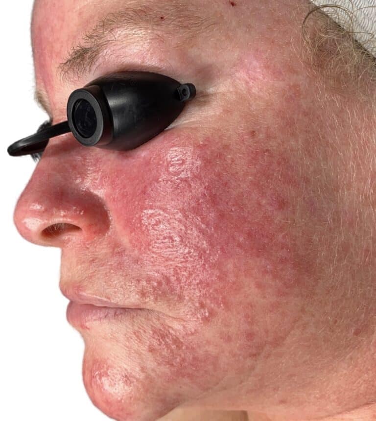 Before Image: Chemical Peel - front
