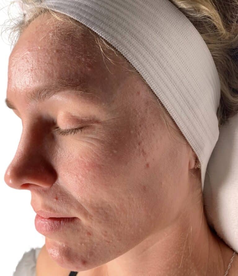 Before Image: Acne Chemical Peel - other