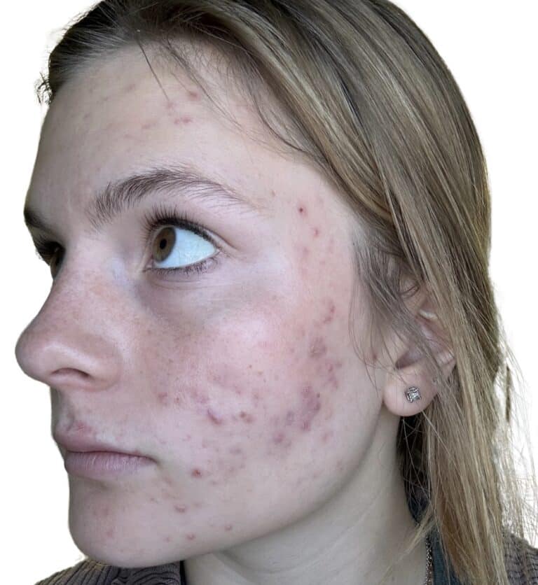 Before Image: Acne Chemical Peel - front