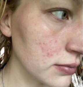 Before Image: Chemical Peel