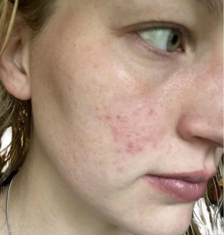 Before Image: Chemical Peel - front