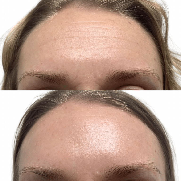 Before Image: Botox/Dysport - front