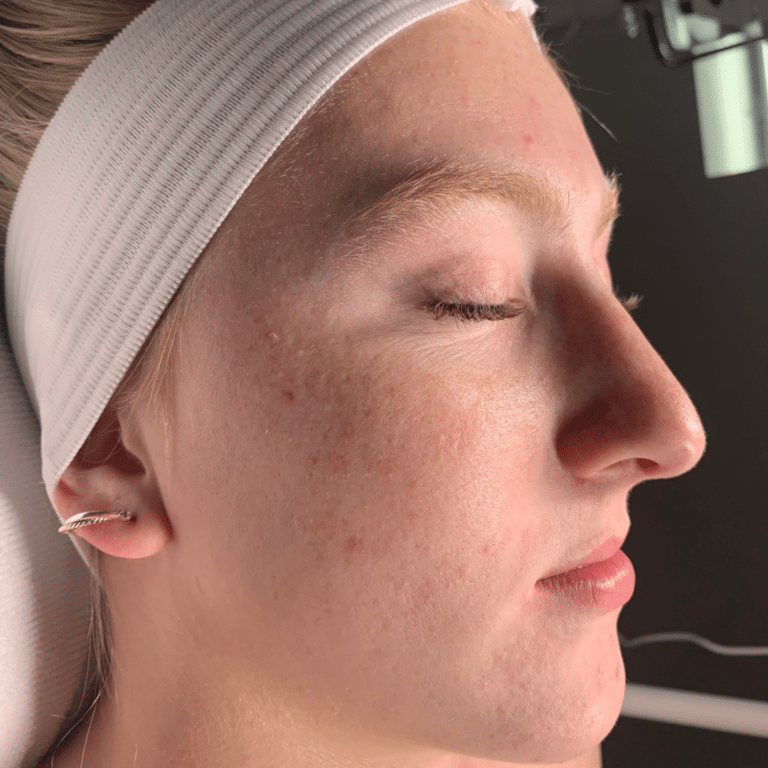 After Image: Acne Chemical Peel - front