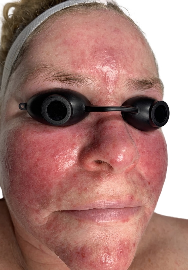 Before Image: Chemical Peel - front