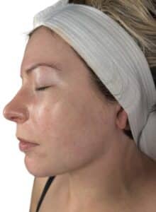 After Image: Chemical Peel