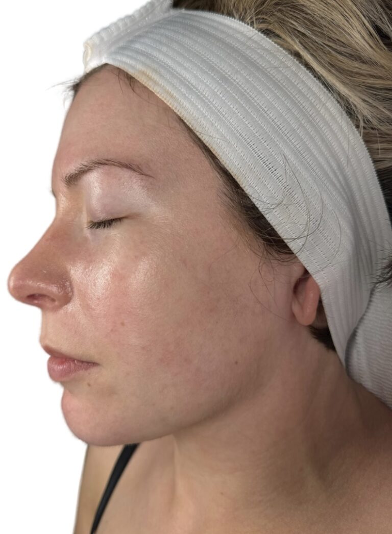 After Image: Chemical Peel - front