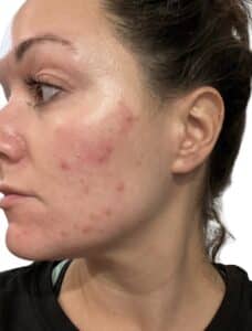 Before Image: Acne Chemical Peel