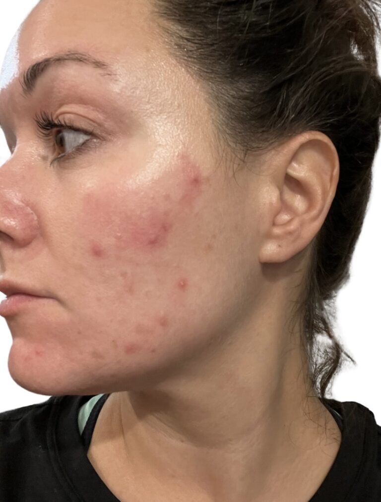 Before Image: Acne Chemical Peel - front