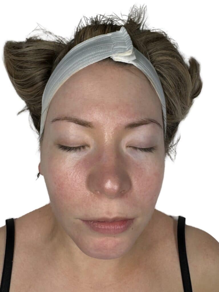 After Image: Chemical Peel -