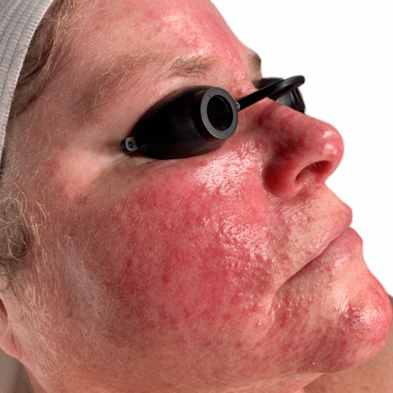 Before Image: Chemical Peel - front