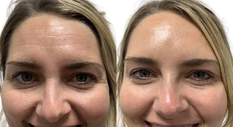 Before Image: Botox/Dysport - front
