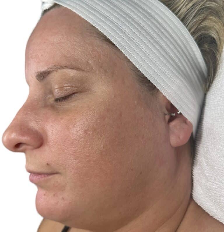 After Image: Microneedling -