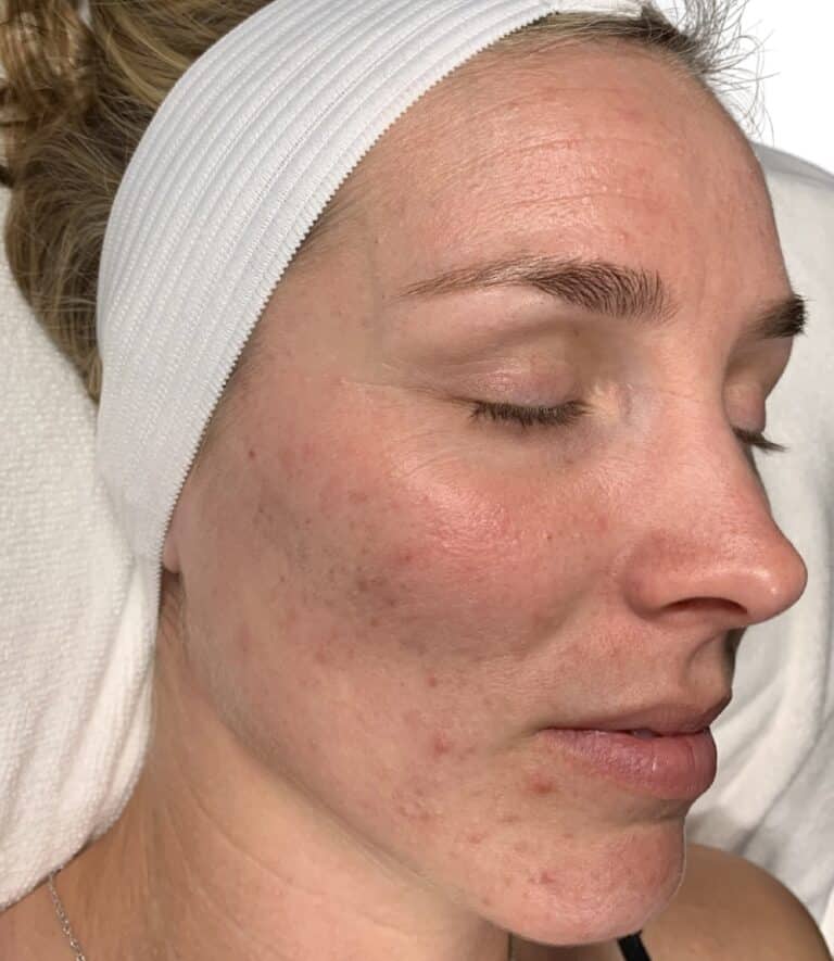 Before Image: Acne Chemical Peel - other
