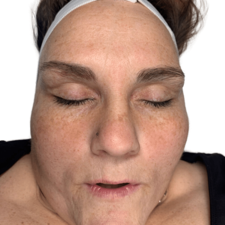 After Image: Chemical Peel - front