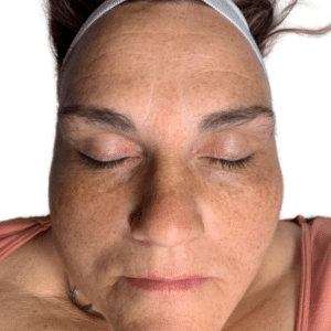 Before Image: Chemical Peel