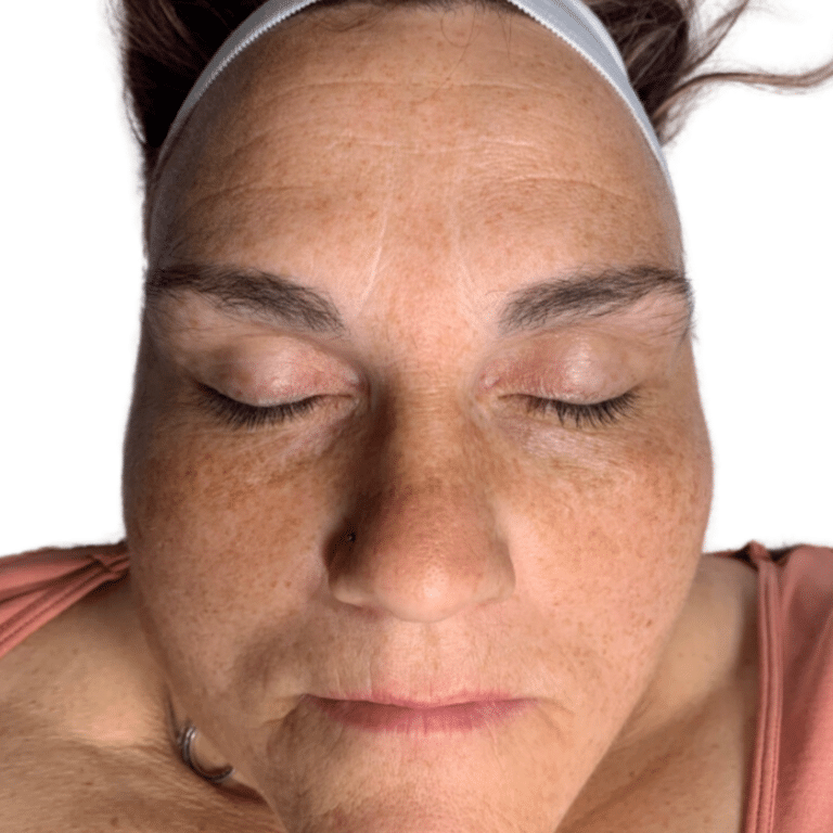 Before Image: Chemical Peel - front