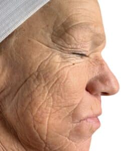 After Image: Chemical Peel