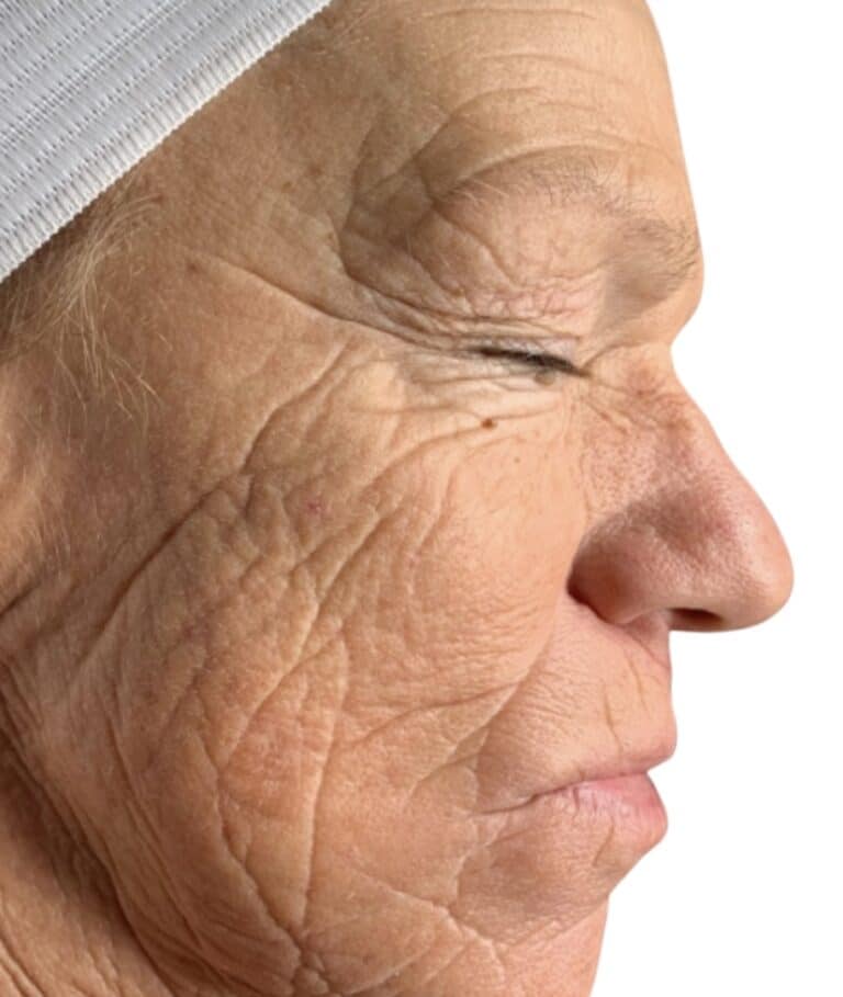 After Image: Chemical Peel - right-side