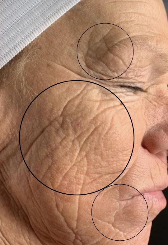 After Image: Chemical Peel - right-side