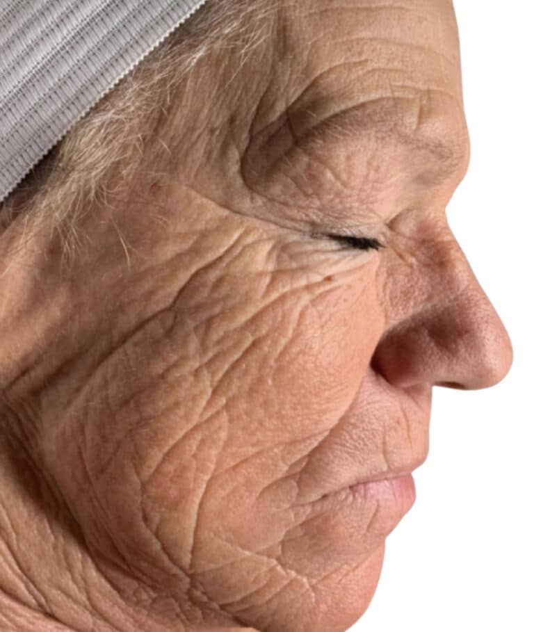 Before Image: Chemical Peel - right-side