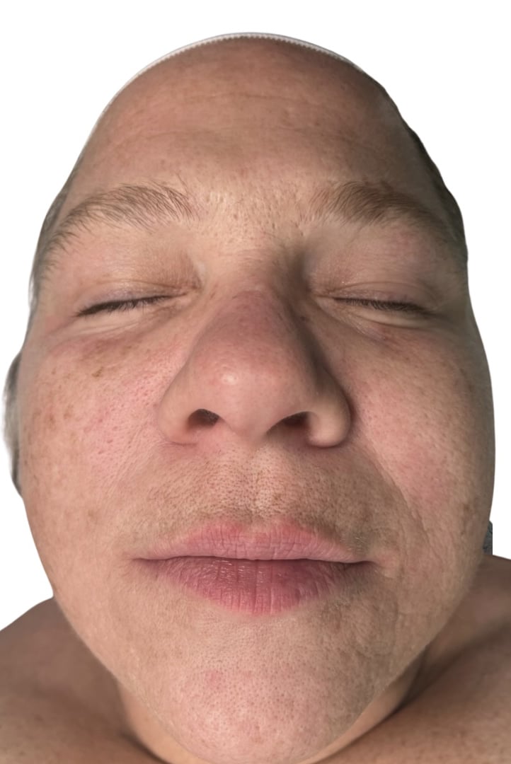 After Image: Chemical Peel - front