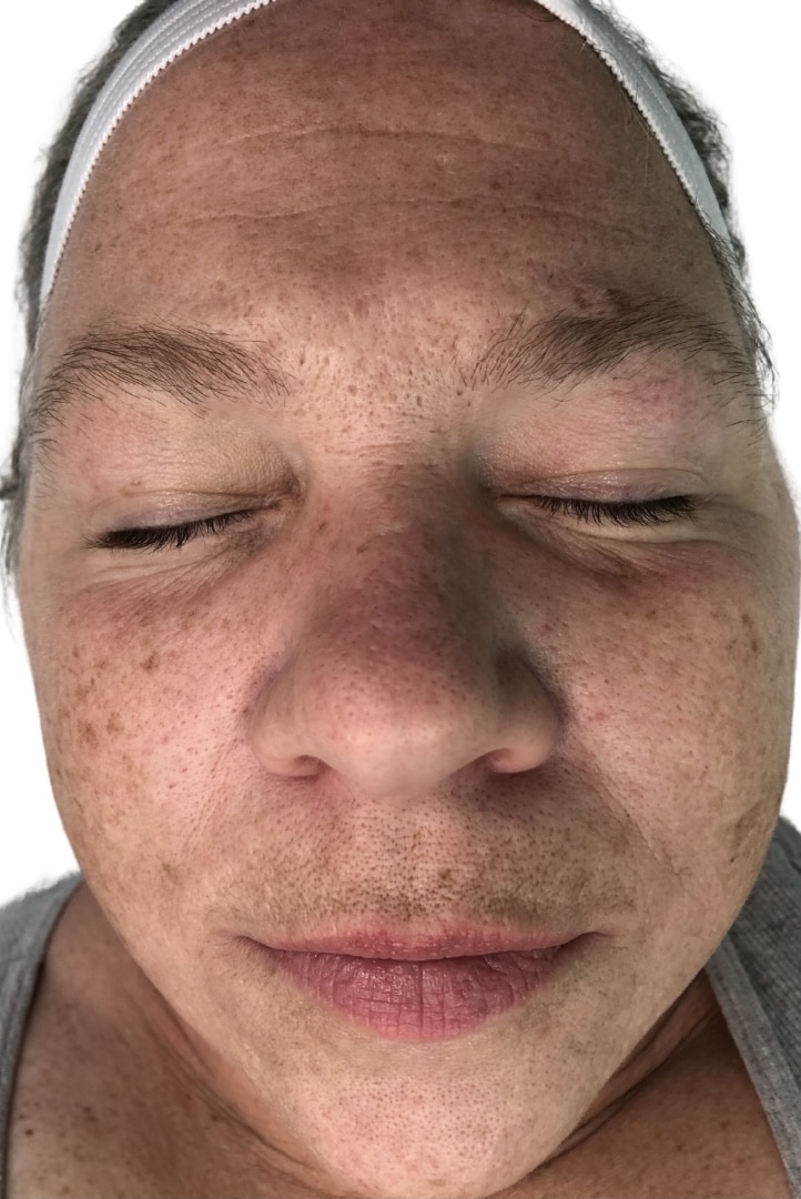 Before Image: Chemical Peel - front