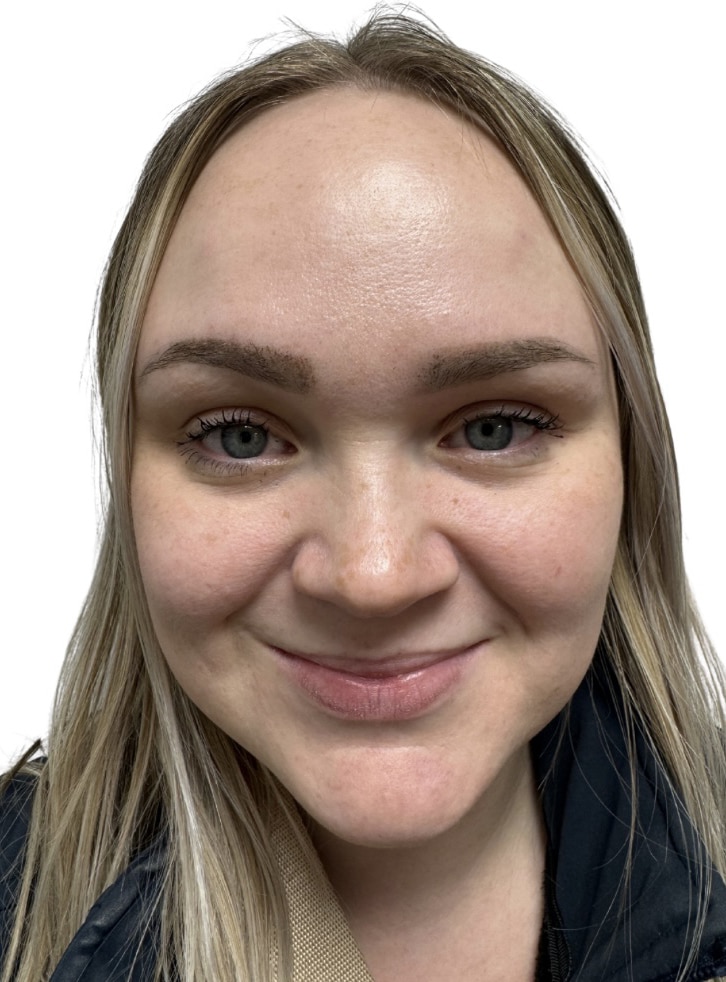 After Image: Botox/Dysport - front