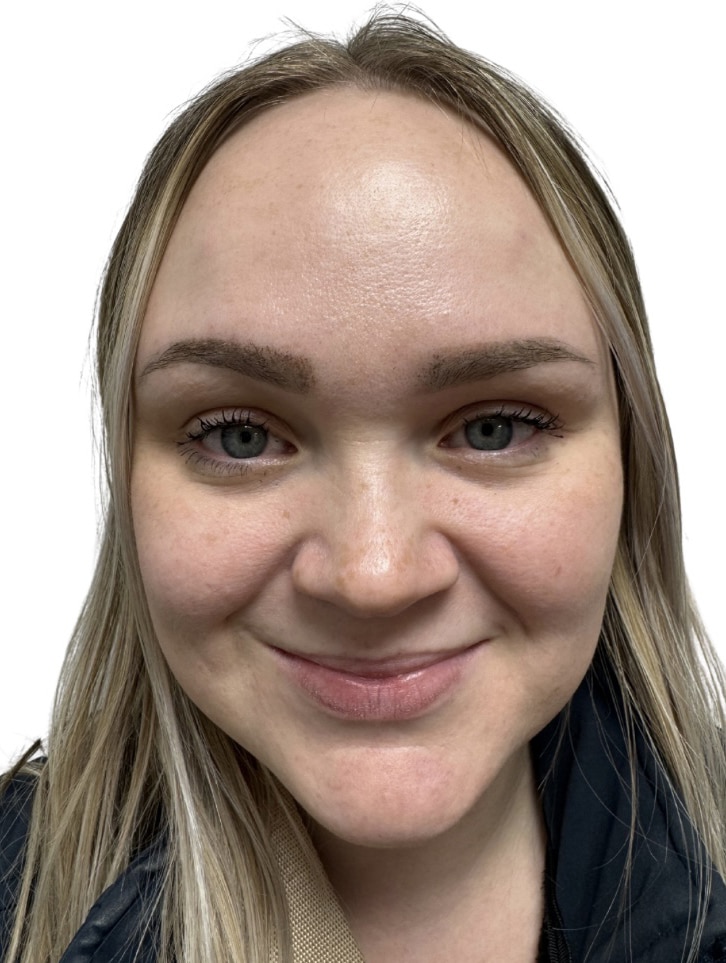 After Image: Botox/Dysport -