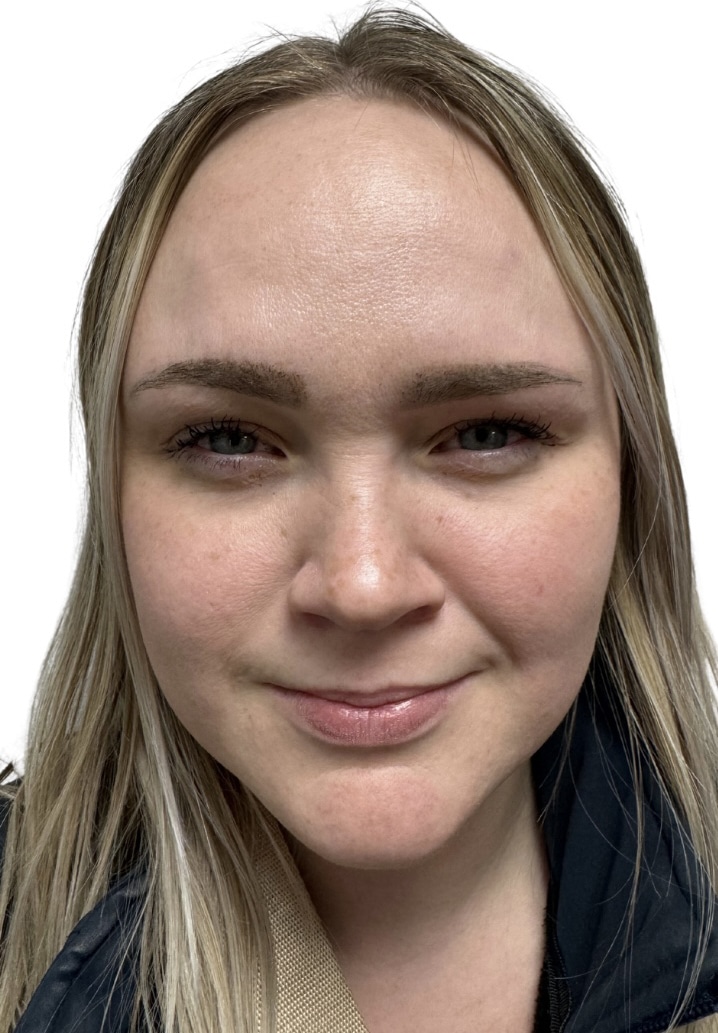 After Image: Botox/Dysport -