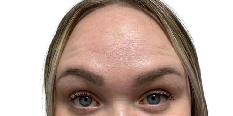 After Image: Botox/Dysport -