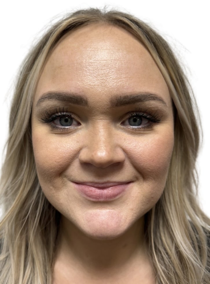 Before Image: Botox/Dysport - front