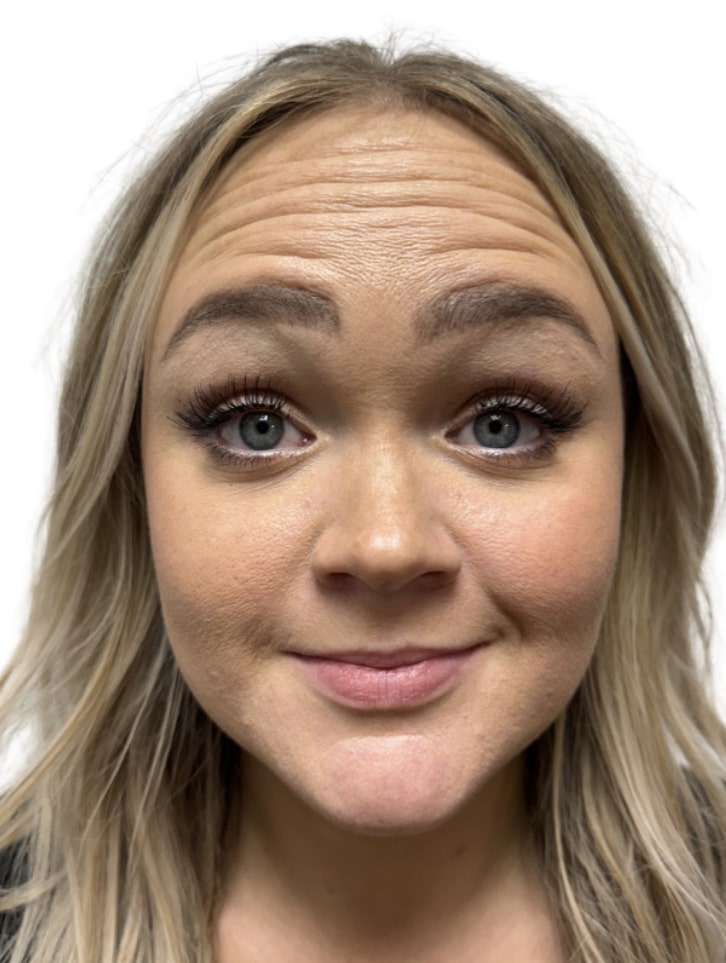 Before Image: Botox/Dysport -