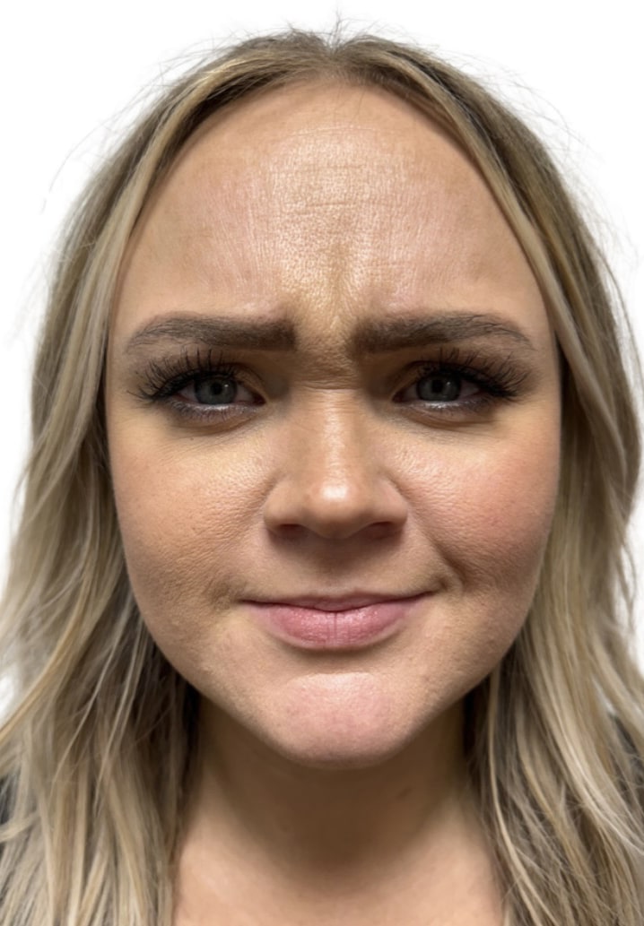 Before Image: Botox/Dysport -