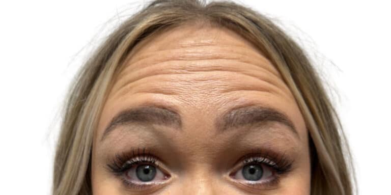 Before Image: Botox/Dysport -