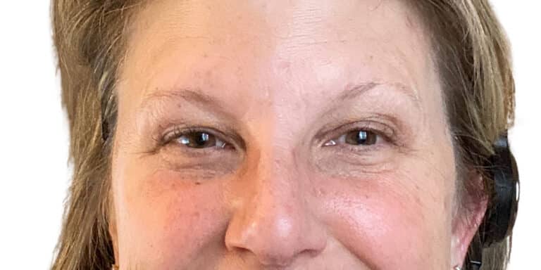 After Image: Botox/Dysport -