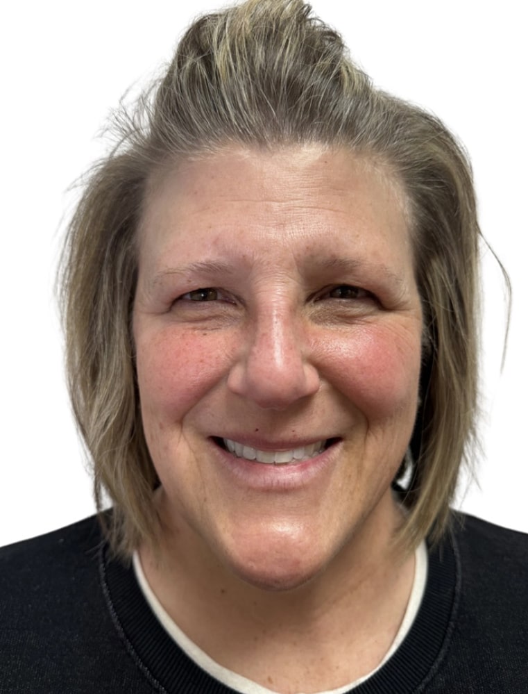Before Image: Botox/Dysport - front