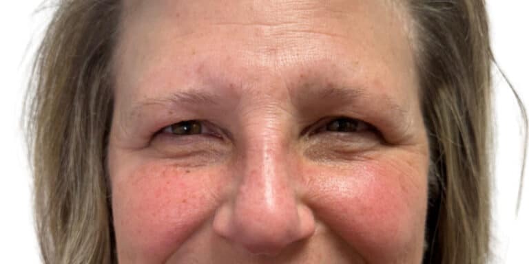 Before Image: Botox/Dysport -