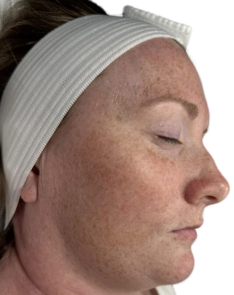 After Image: BioRePeel - right-front-oblique