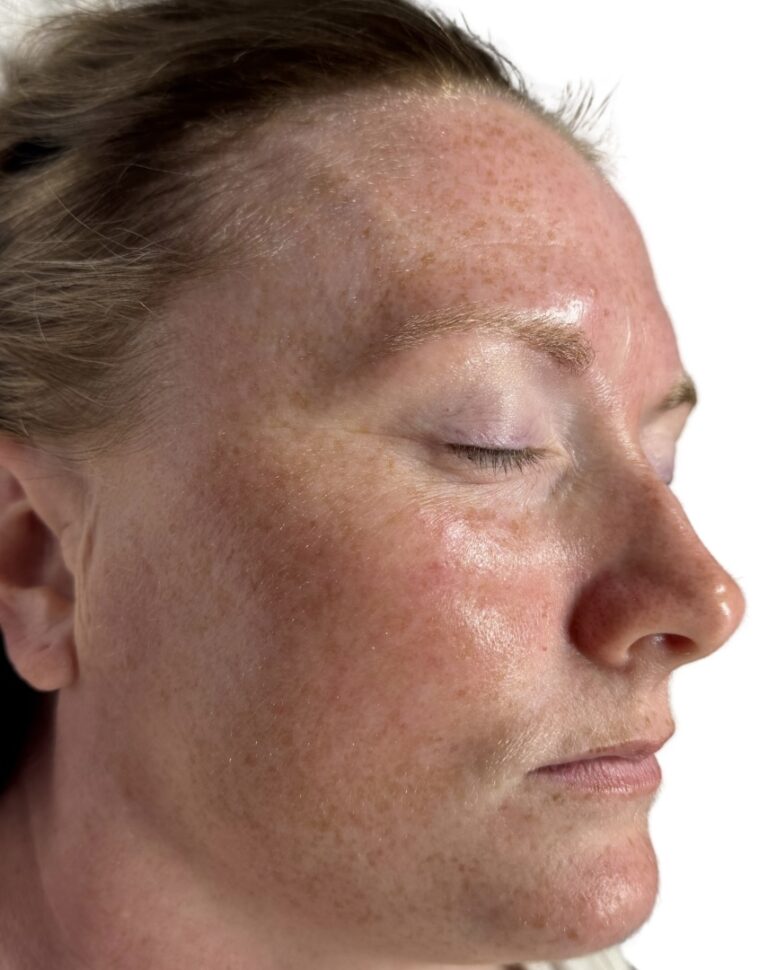 Before Image: BioRePeel - right-front-oblique