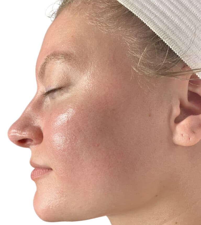 After Image: Dermaplane Facial - left-side