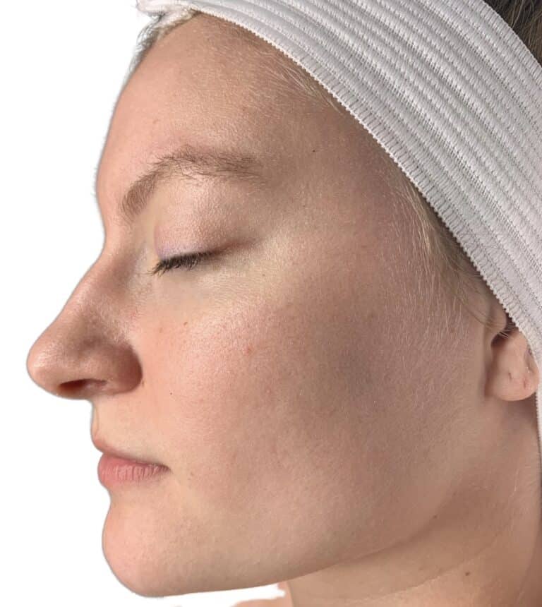 Before Image: Dermaplane Facial - left-side